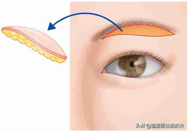 想做“提眉手术”的人，听医生讲讲这25个真相