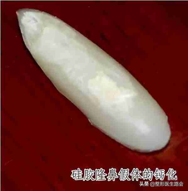 硅胶隆鼻是永久的吗？用它做鼻子有什么危害吗？