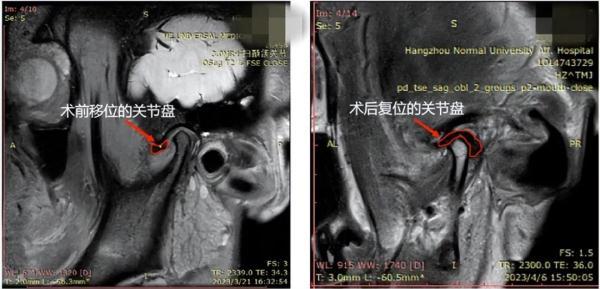 突然张不开嘴，连饭都吃不了！这个面部高发疾病要警惕