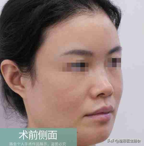 30岁+女士赴京整形，膨体隆鼻+鼻基底填充全记录，5个月后大变样