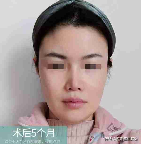 30岁+女士赴京整形，膨体隆鼻+鼻基底填充全记录，5个月后大变样