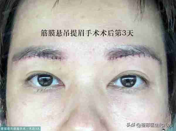 49岁眼皮松弛做提眉还是全切双眼皮？女士选择提眉手术，术后13天