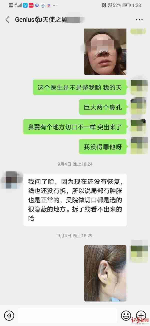 如此整形！取耳软骨做鼻头整形，鼻子好看了耳朵有个缺口 当事人：耳机都挂不住