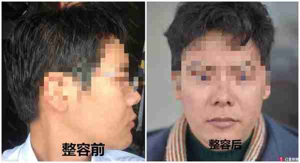 男子花1.2万隆鼻后竟能晃动 美容院：属正常误差范围内