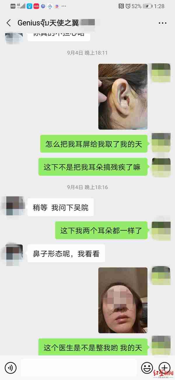 如此整形！取耳软骨做鼻头整形，鼻子好看了耳朵有个缺口 当事人：耳机都挂不住