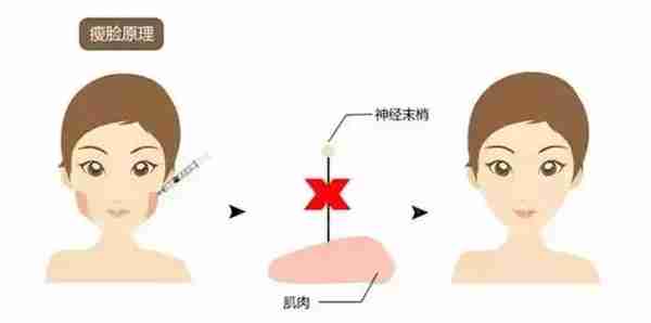 关于瘦脸针的N个真相你要不要听