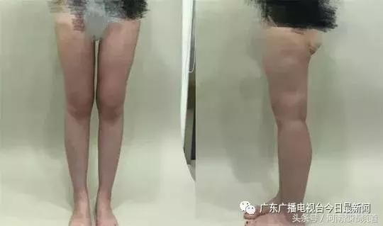 江苏23岁女子花1万5做吸脂术，半年后腿上全是坑！