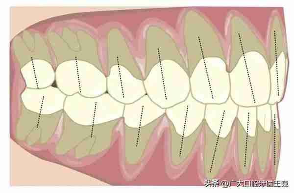 正畸必读｜除了排齐牙齿让你更美，牙齿矫正的8大好处你知道吗？