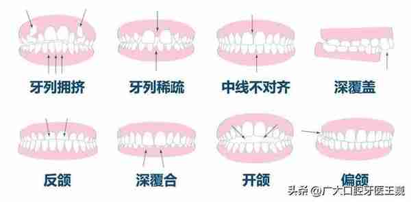 正畸必读｜除了排齐牙齿让你更美，牙齿矫正的8大好处你知道吗？