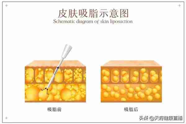 吸脂会让皮肤松垮？脂肪填充会移位？来听听八大处医生怎么说