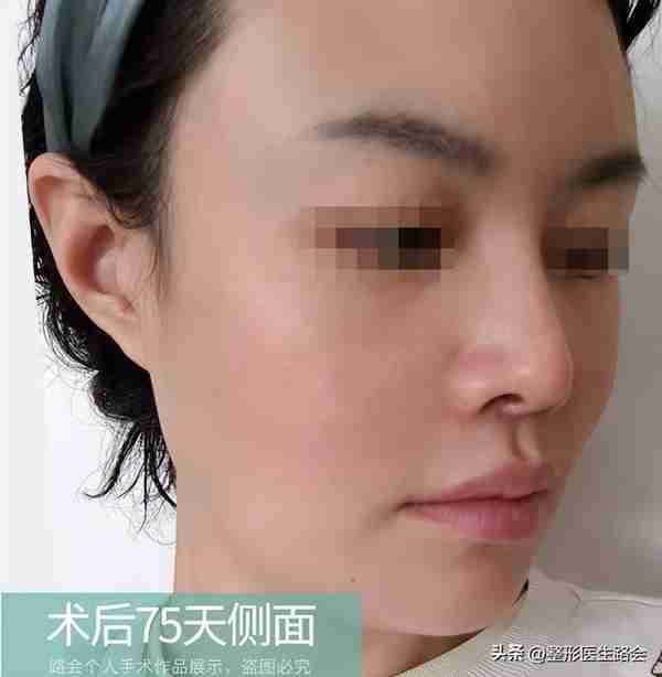 30岁+女士赴京整形，膨体隆鼻+鼻基底填充全记录，5个月后大变样