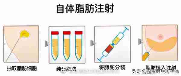 一次性说清“吸脂”，顶你做半年功课！（下）