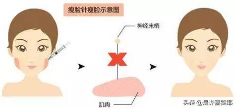 关于瘦脸针，你们想了解的都在这儿了