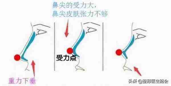 硅胶隆鼻是永久的吗？用它做鼻子有什么危害吗？