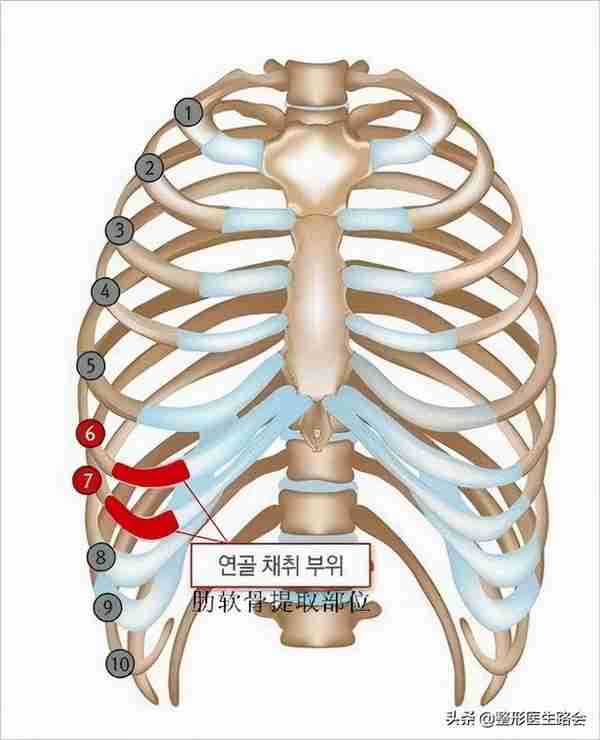 网上大热的肋骨鼻到底怎么样？取肋软骨会对身体有影响吗？