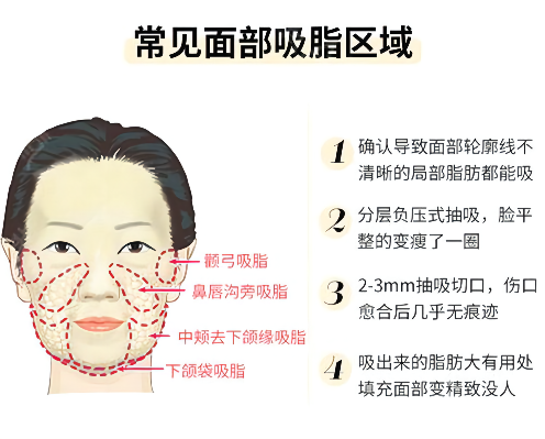 面部吸脂后应该做好哪些护理？