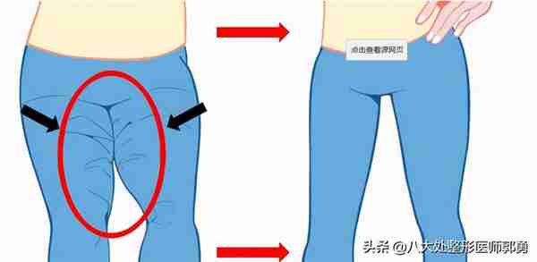 是不是任何一个肥胖部位都可以吸脂呢？