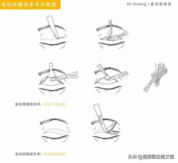 想做双眼皮？这些手术方式你会选吗？